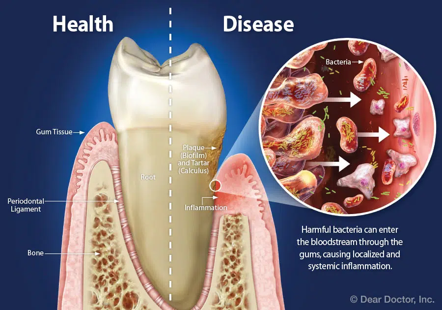 healthy-gum-tissue-vs-diseased