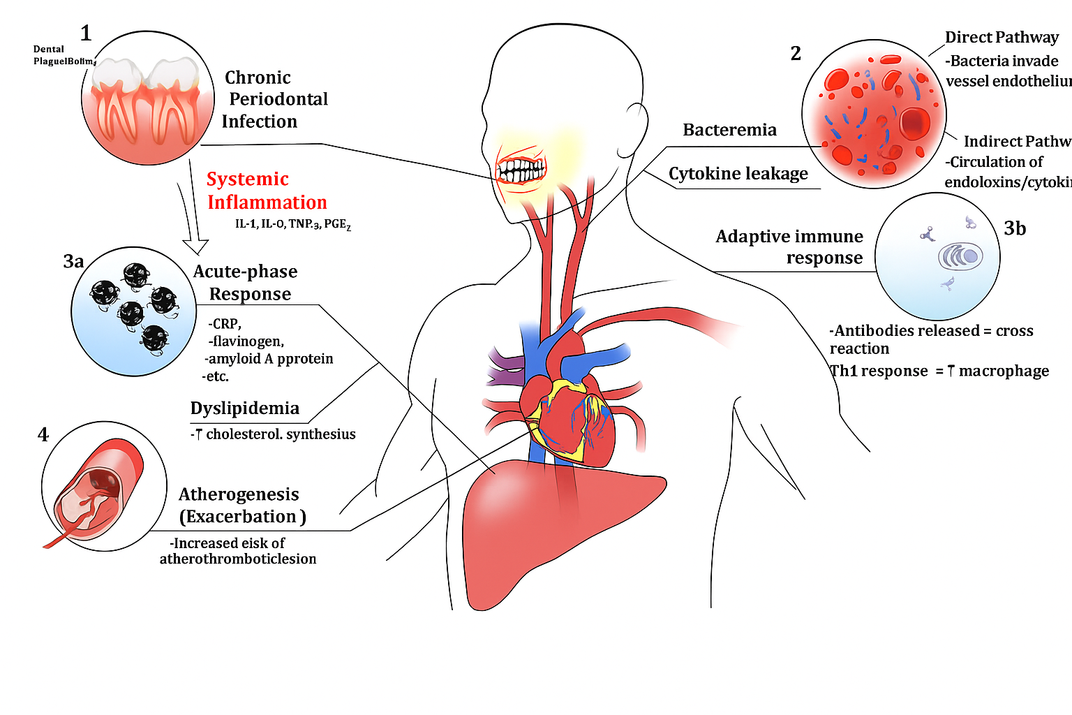 Connection Between Periodontal Infection and Atherogenesis